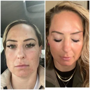 CO2 resurfacing before and after results